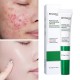 کرم ضد جوش و آکنه سالیسیلیک اسید بیوآکوا BIOAQUA SALICYLIC ACID ACNE REMOVAL