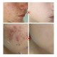 ماسک سالیسیلیک اسید ضد جوش و آکنه SALICYLIC ACID ACNE