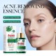 سرم ضد جوش و آکنه و کنترل چربی پوست عصاره چای سبز سادور SADOER TEA TREE ACNES OIL CONTROL FACE SERUM